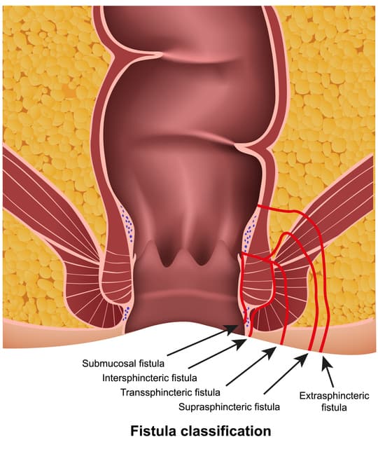 Piles Treatment