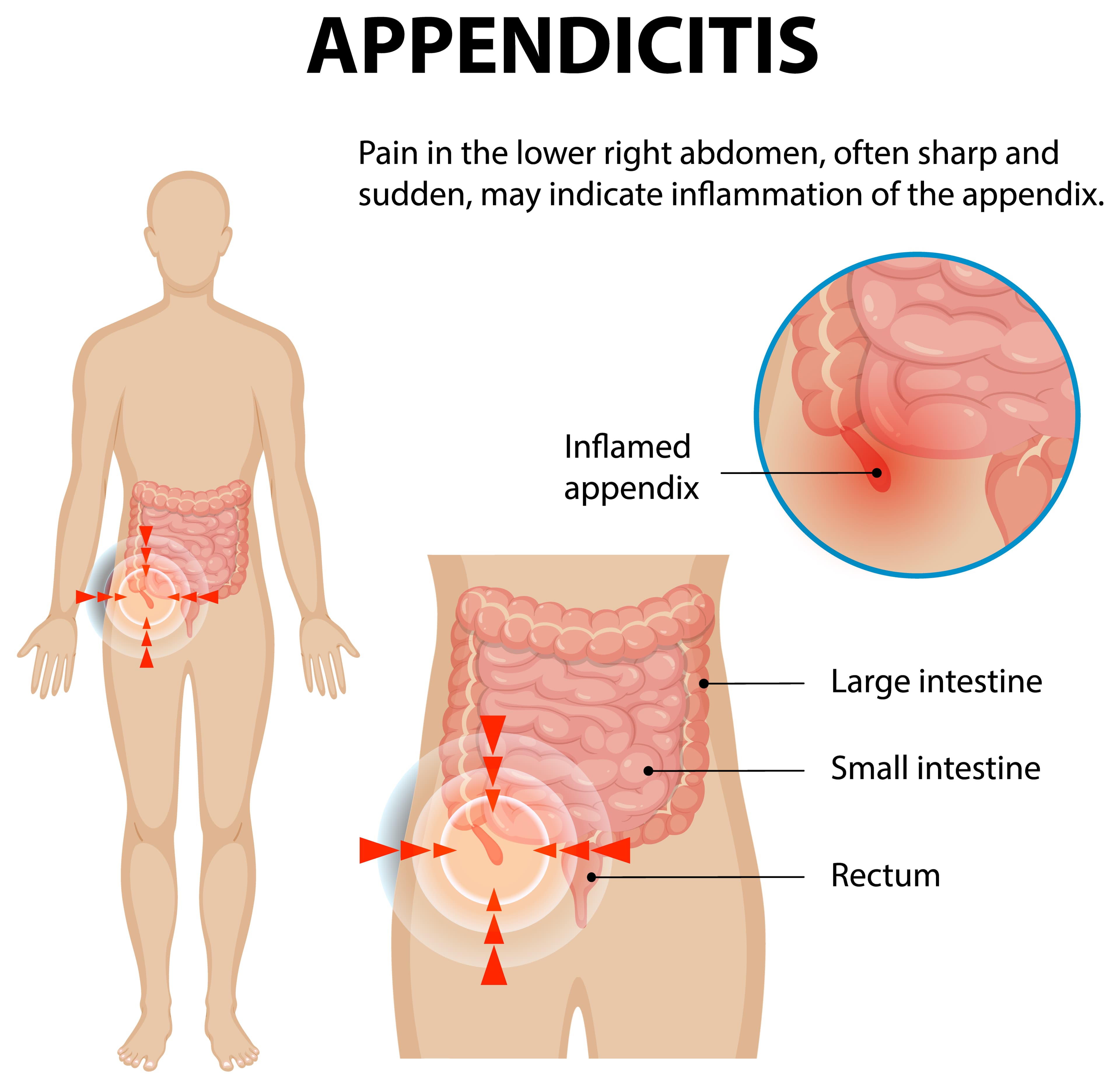 AppendicitisImg1
