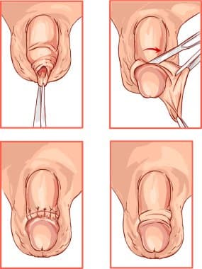 Circumcision