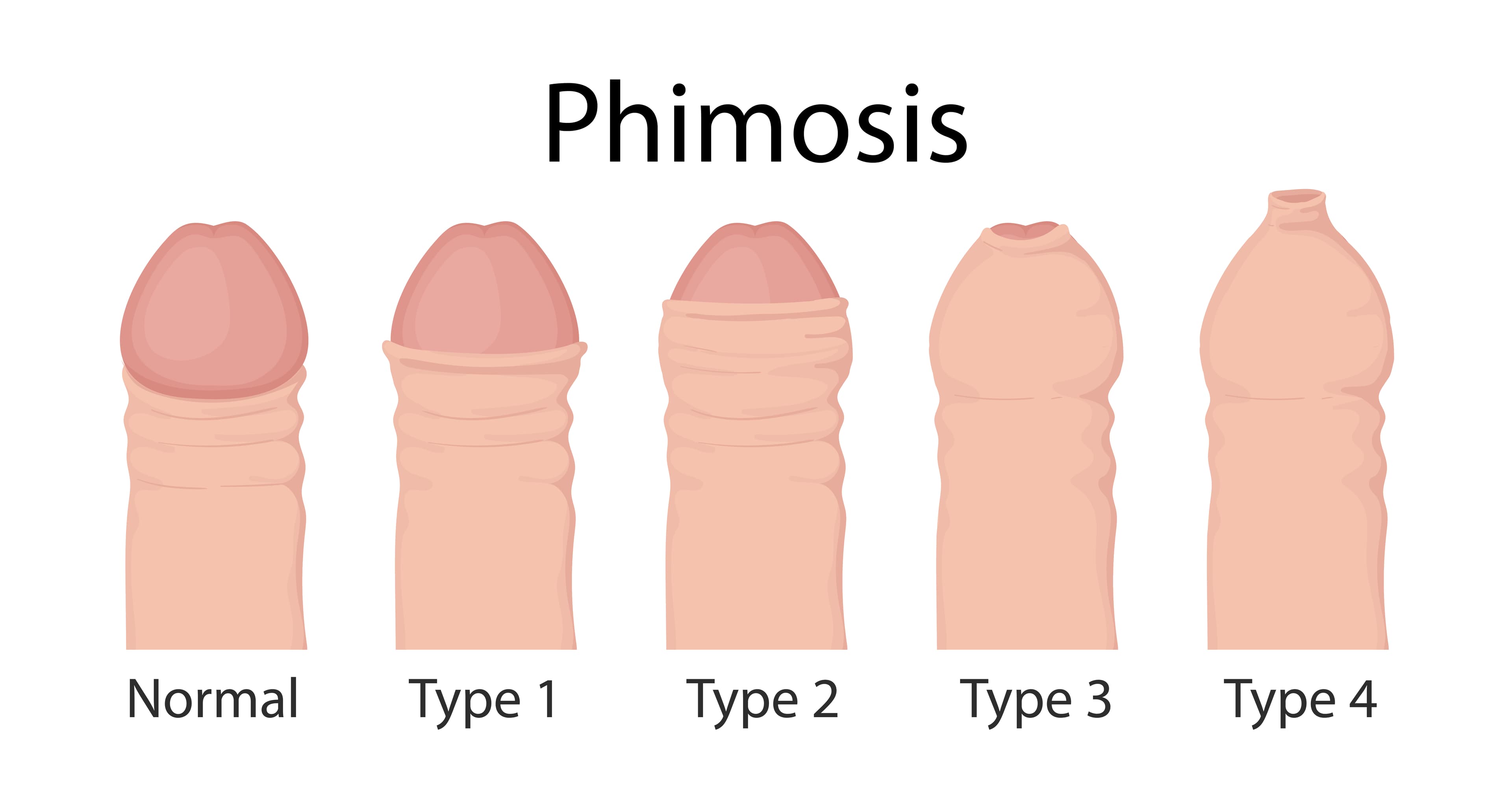 Phimosis