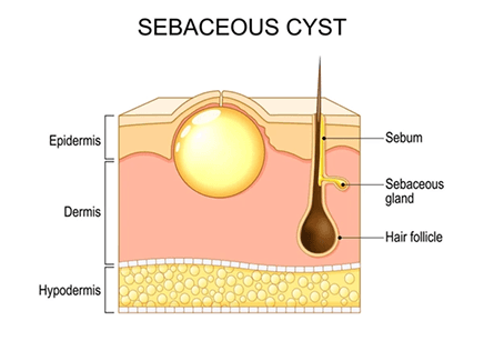 Cysts_SwellingImg2