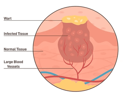 Cysts_SwellingImg3