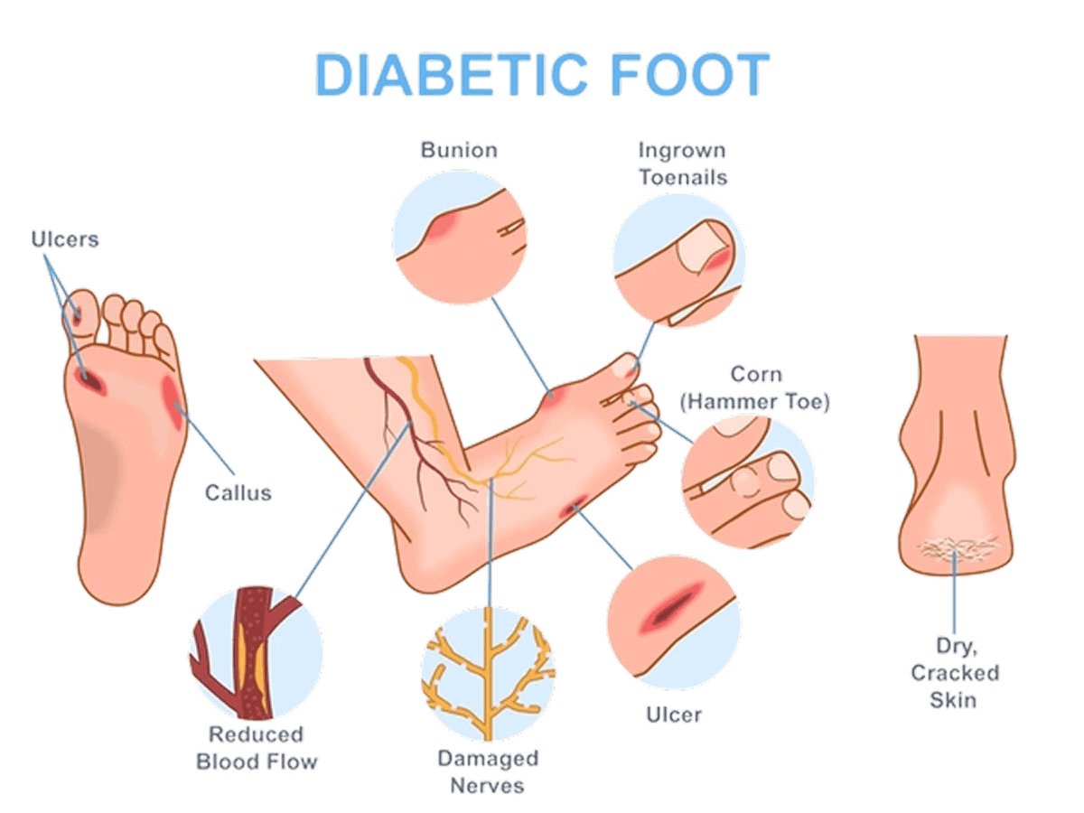 Diabetes Treatment