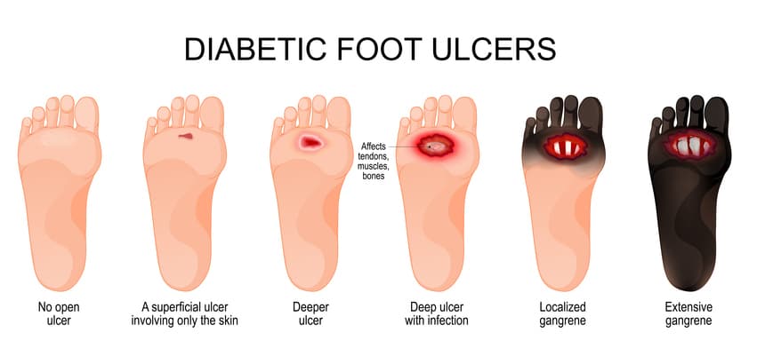Diabetes Treatment