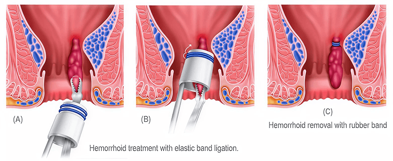 Hemorrhoid ligation with elastic band.