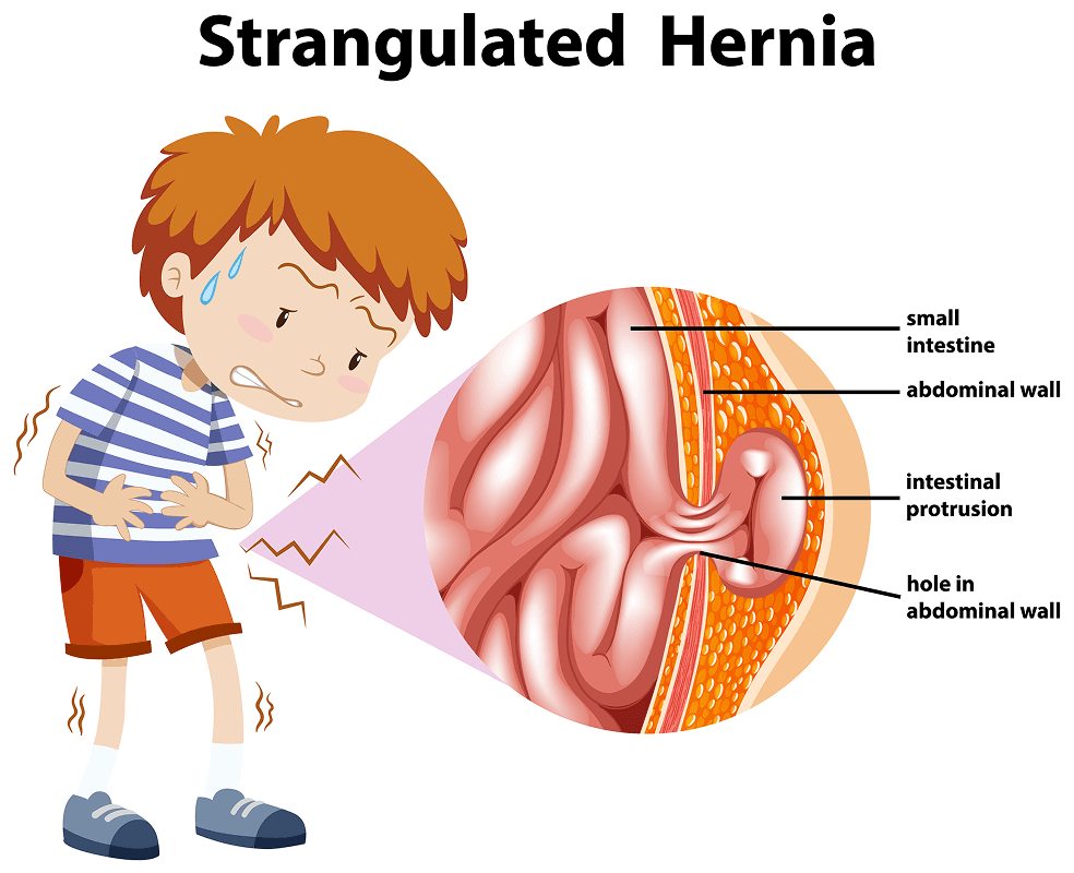 HerniaImg1