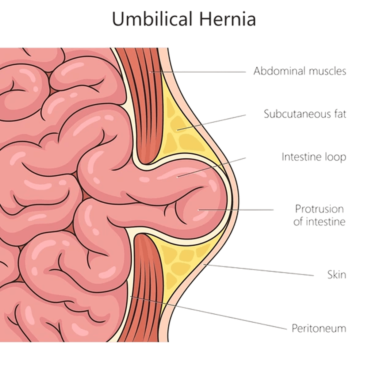 Hernia