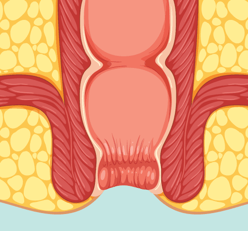 Piles Treatment