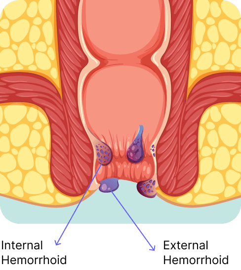 Piles Treatment