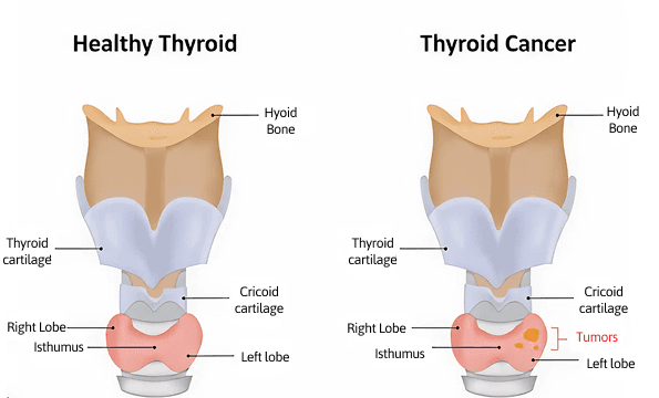 ThyroidImg1