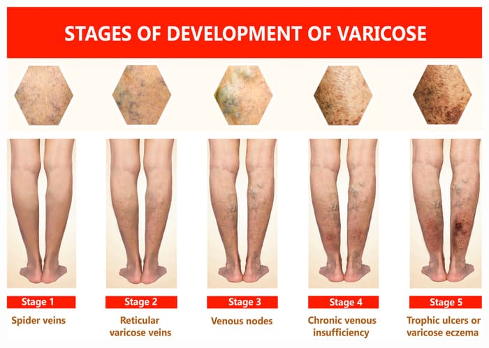 Varicose Veins
