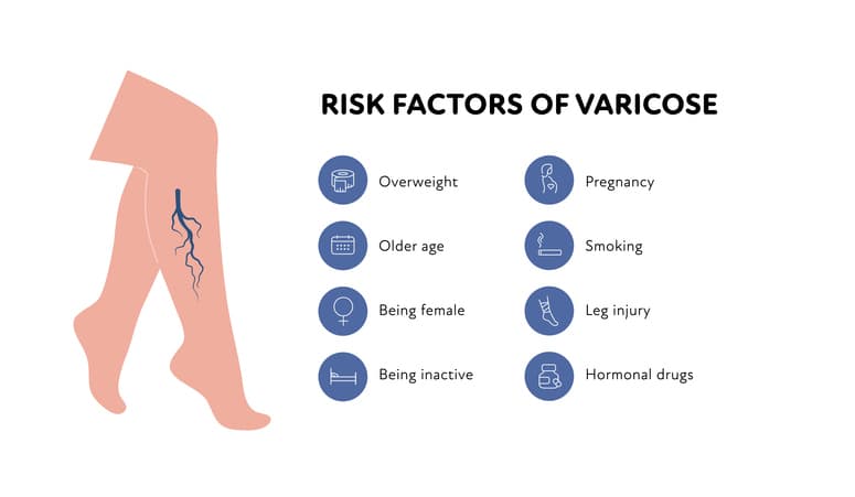 Varicose Veins