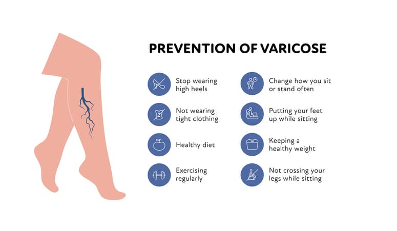 Varicose Veins