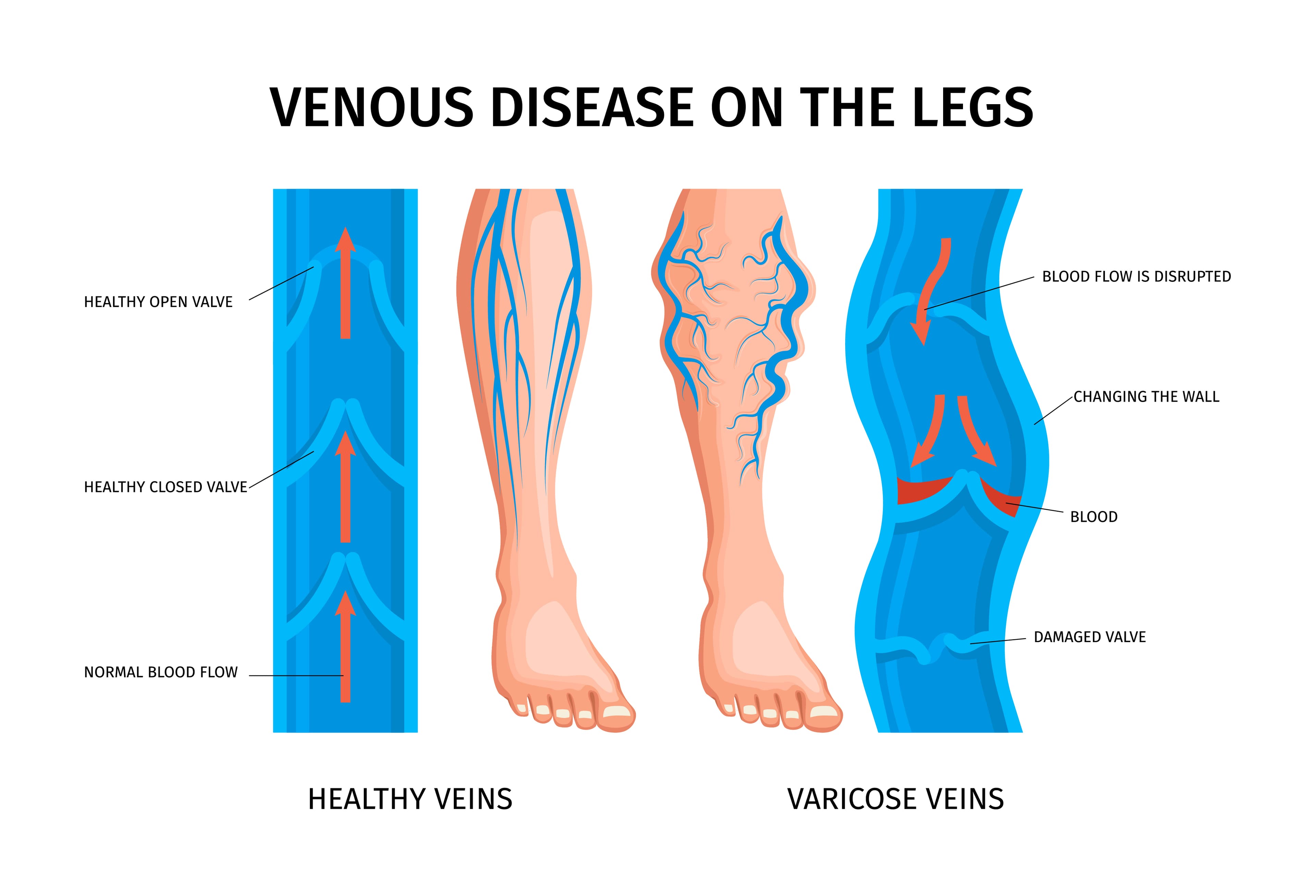VaricoseVeinsImg1