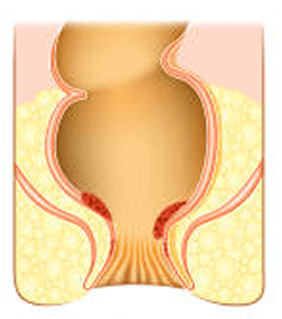 Piles Classification