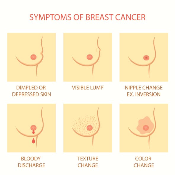 fibroadenoma