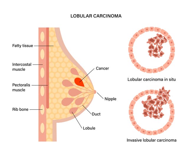 fibroadenoma