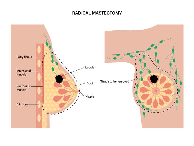fibroadenoma