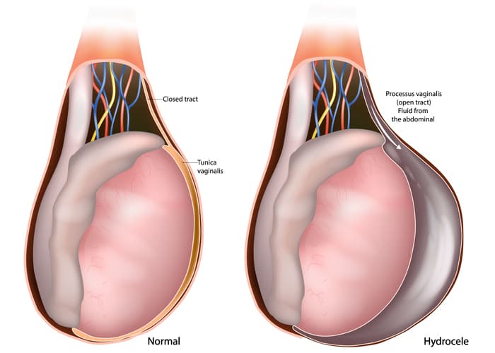 hydrocele