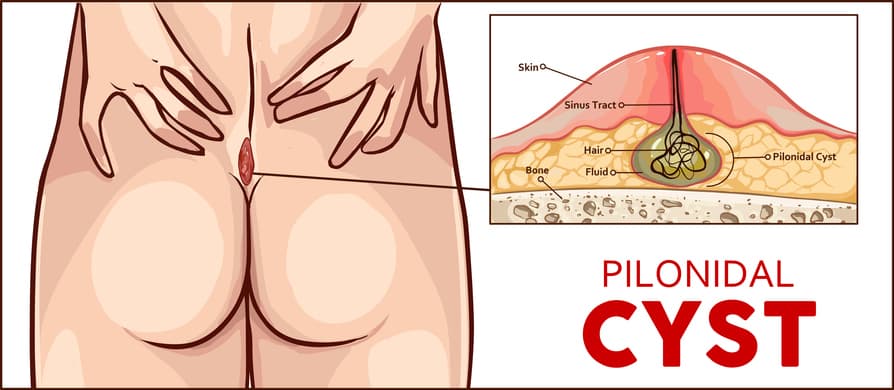 pilonidal Sinus