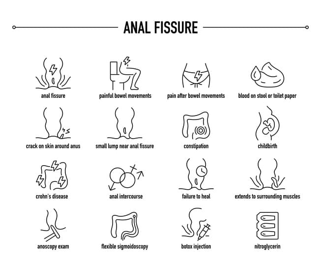 Anal fistula