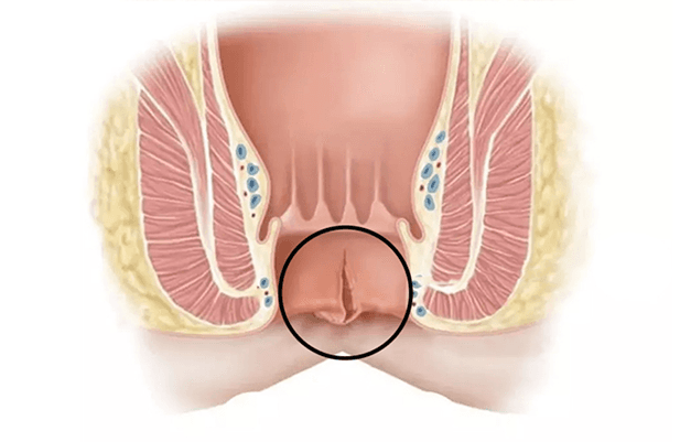 FissureSymtomsimg