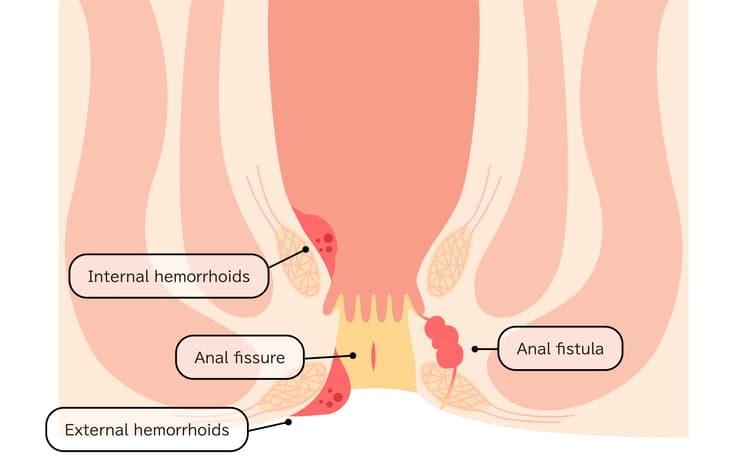 Piles Treatment